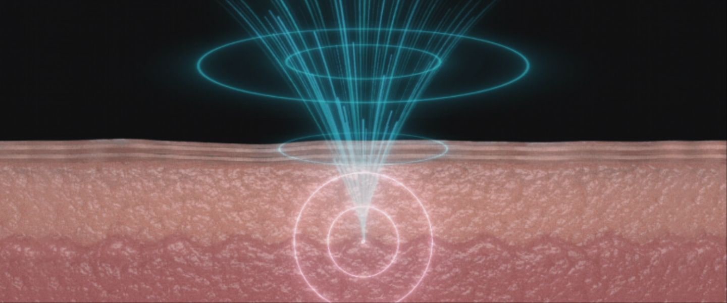 An image showing the formation of collagen and elastin in a 3mm layer in the skin.