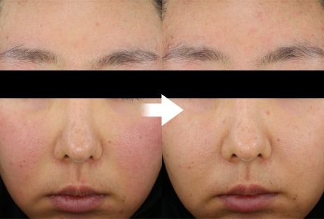 Image showing calmed skin after use compared to before	