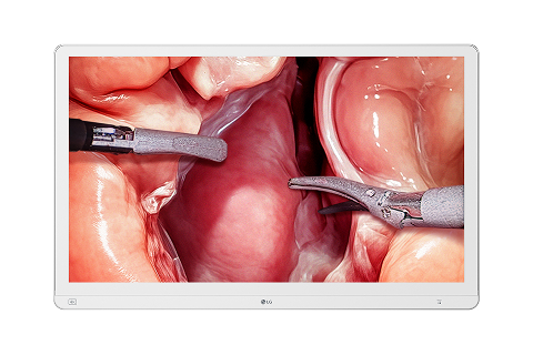 A medical monitor displays a close-up view of a surgical procedure showing internal tissues and instruments.